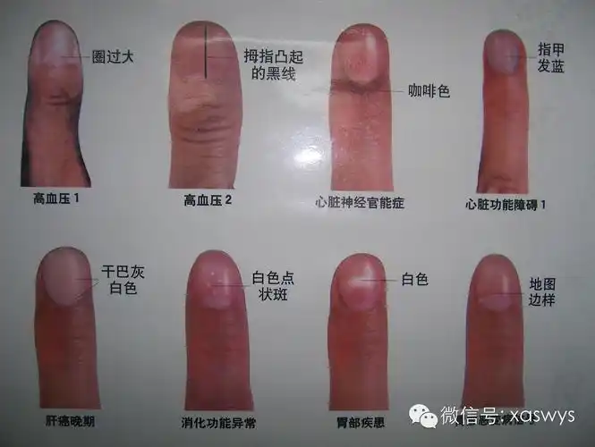 通过望手指甲就能诊断出疾病-指甲诊病法