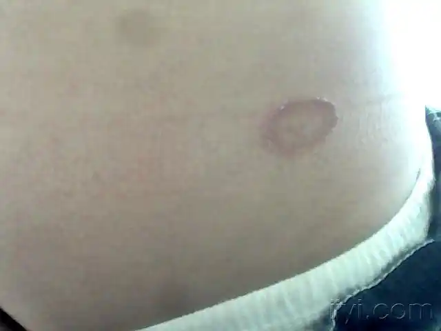 七岁男孩圆形皮疹