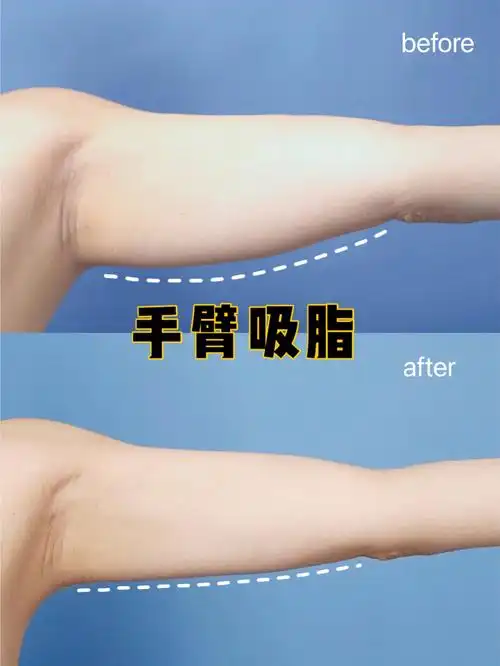 吸脂瘦手臂前后效果对比