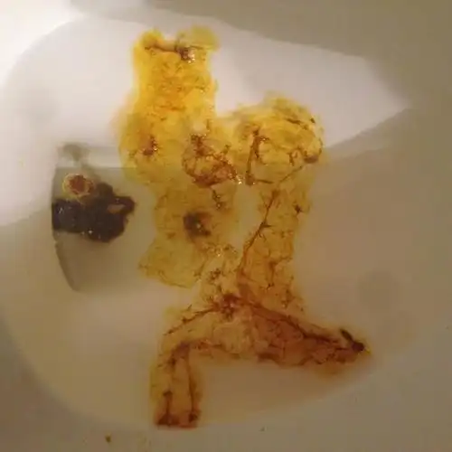 大便时会感到很痛之外,还可能会出现粘糊糊的排泄物,或者是一些粘液