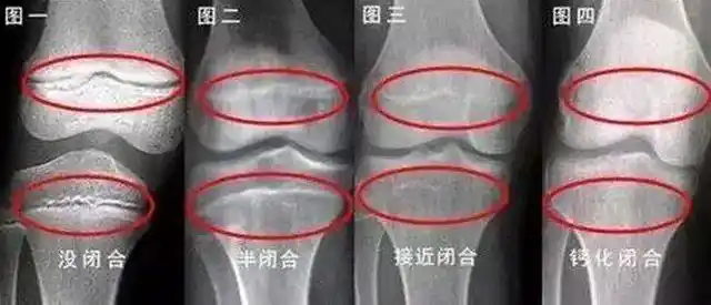 儿童每根长骨的两端都有骨骺线,当骨骺线还未闭合的时候(如下图),会