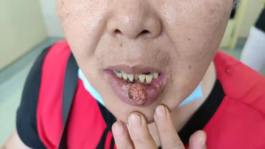 下唇疣状增生物!-魏国主任医师-爱问医生