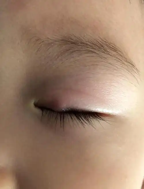 宝宝霰粒肿自愈经历:不手术也能好!