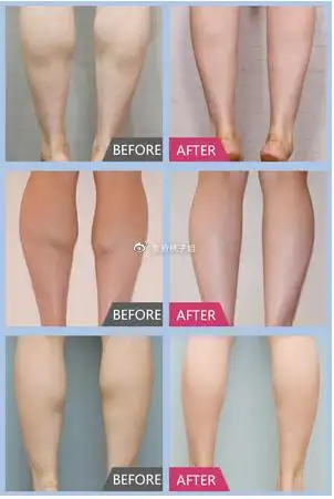 肉毒素瘦小腿前后对比图