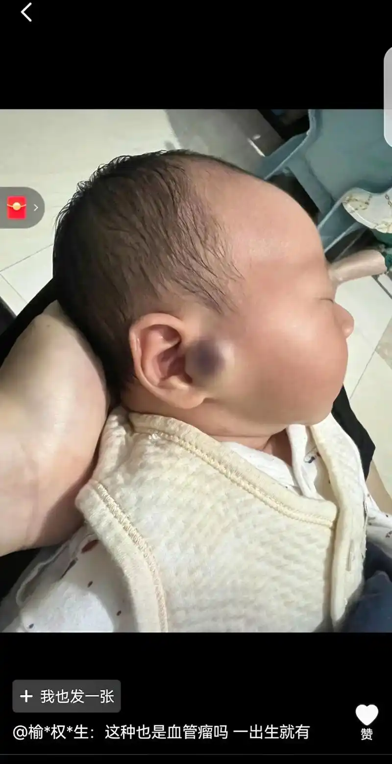 截取评论区一小部分宝宝血管瘤照片,感谢家长的信任.