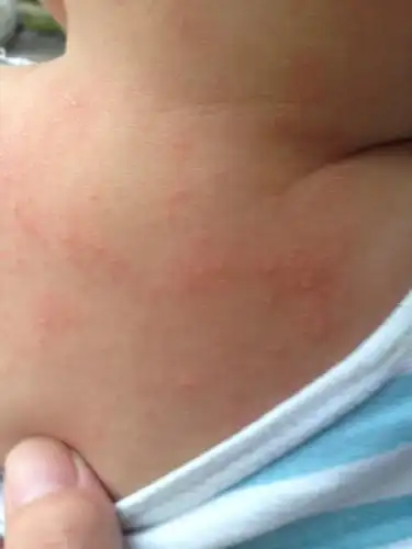 问:宝宝身上长了许多,不知是痱子还是湿疹,有答案必采纳.