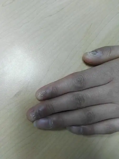 扁平苔藓lp的治疗