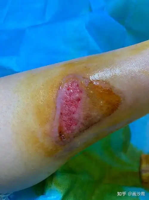 记录摩托车烫伤三度恢复过程