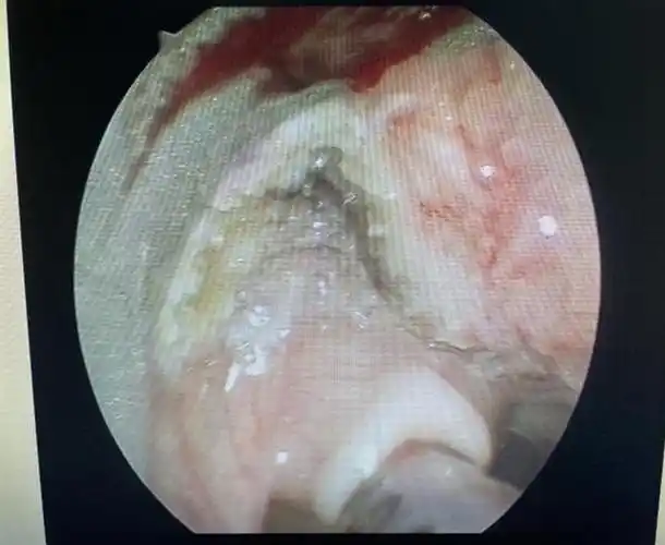 真如鲠在喉济一2个月小孩嗓子里长了巨大肿瘤