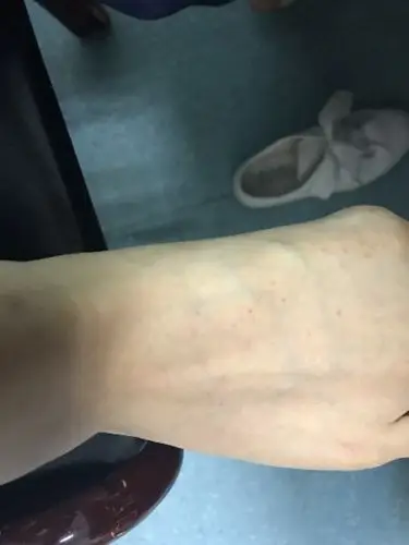 两个脚背上起了红点 不疼不疼 摸起来微微有些凸起