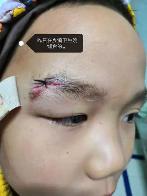 当天在局麻下行眼睑裂伤缝合术后.