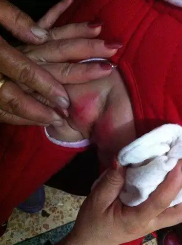 新生婴儿20天左右!屁股已经红成这样!请问那位好心专家能够帮忙!