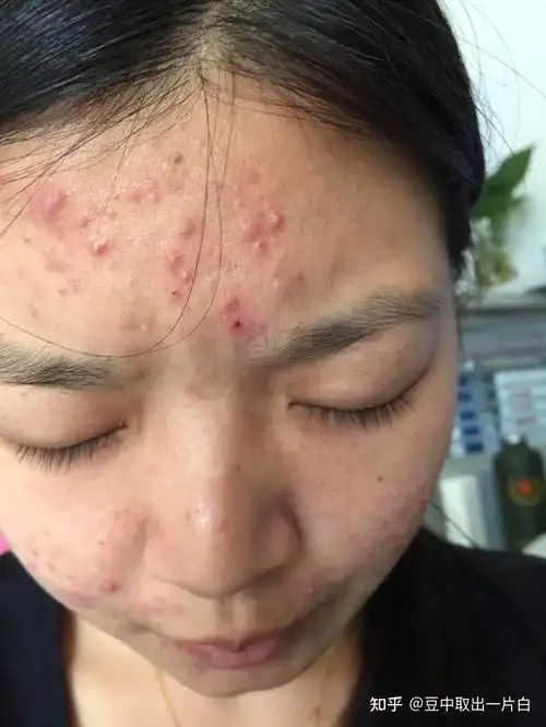 丘疹,炎症性痘痘去医院治疗好还是去祛痘机构好呢? - 知乎