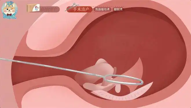 图文|人工流产|子宫|引产|胎儿_网易订阅