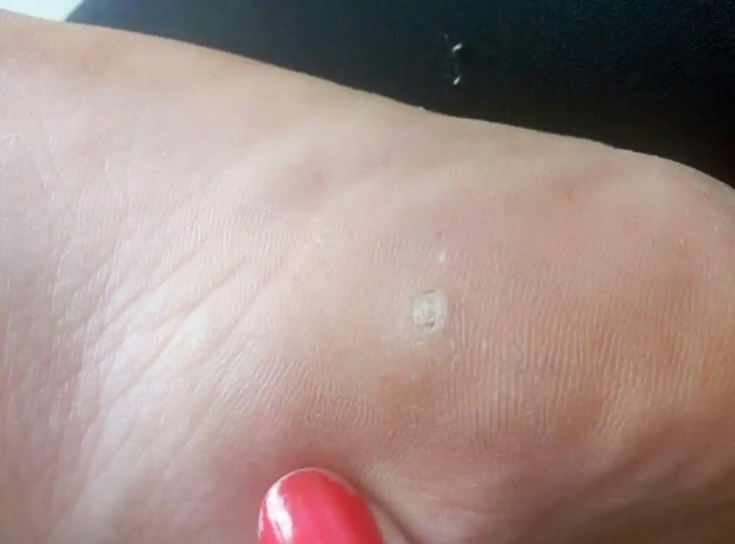 跖疣是脚掌处类似老茧的皮损,多不会恶变,具有传染性