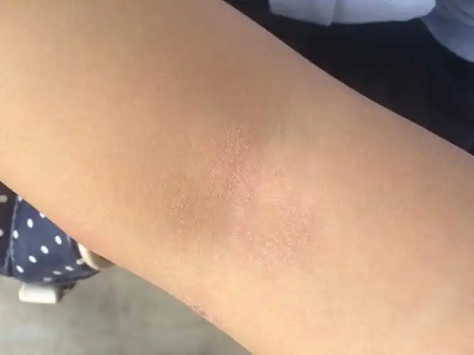 最近两个手臂出现这个不知道怎么回事