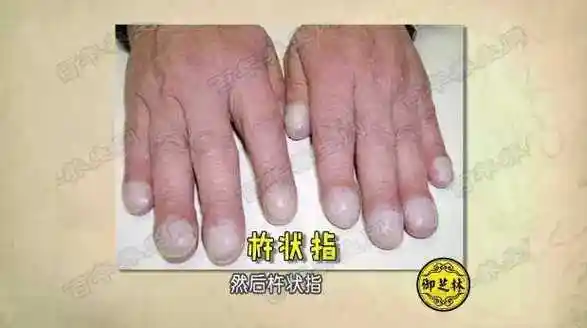 20160404饮食养生汇视频和笔记郭玉琴肺间质纤维化山药烧口蘑