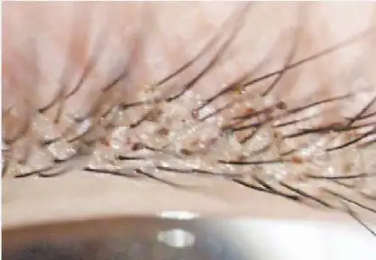 外阴阴虱的症状有哪些