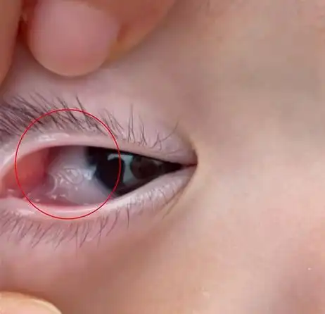 8个月男婴眼里取出8条寄生虫,医生:跟家里养宠物有关