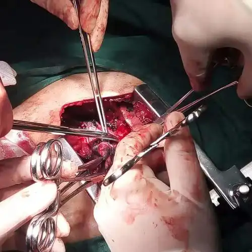 盐源县人民医院心胸血管外科成功开展1例肺叶切除术