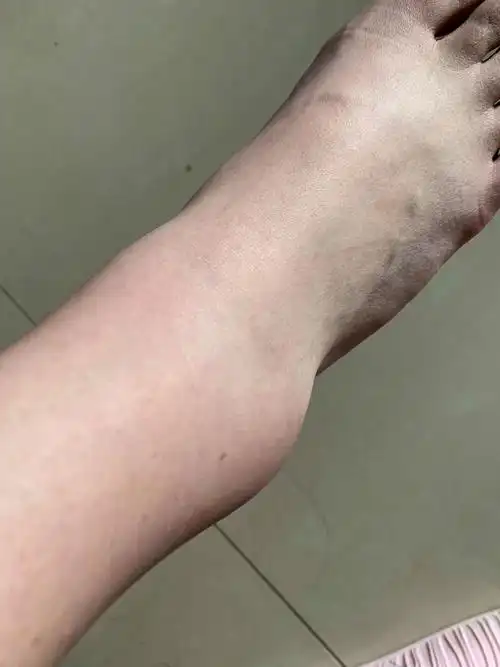 崴脚了一周不见好要怎么办