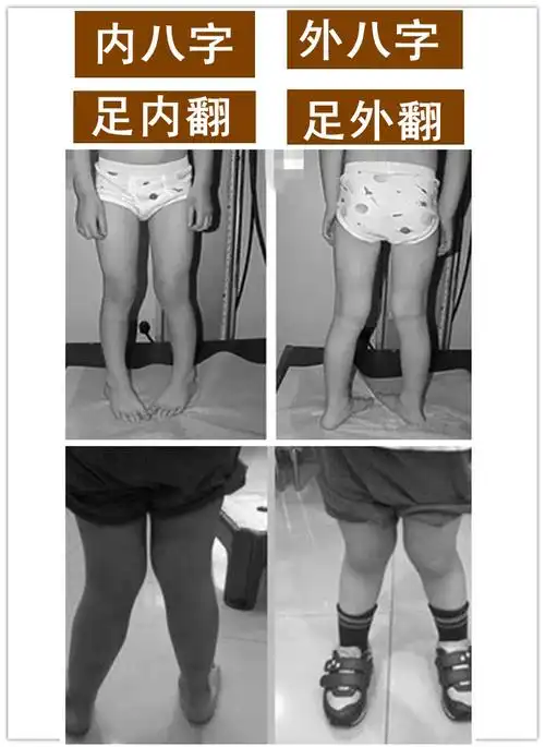 7岁儿童内八字如何纠正,小孩走路内八字,有什