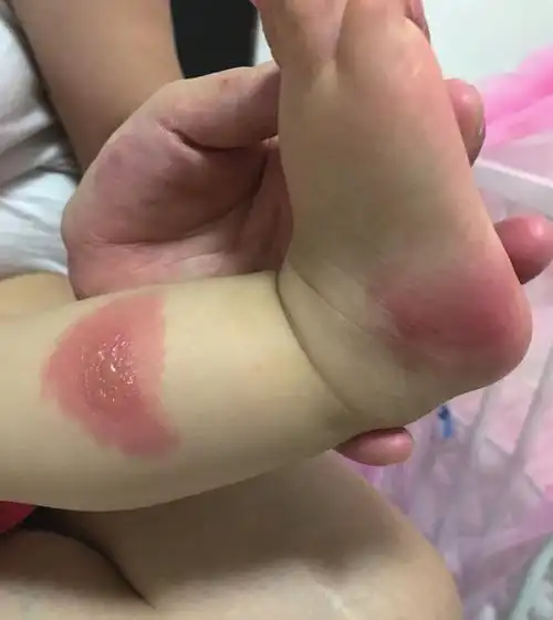 小伙被蚊子叮咬后过敏 全身长满小疙瘩痒得睡不着觉