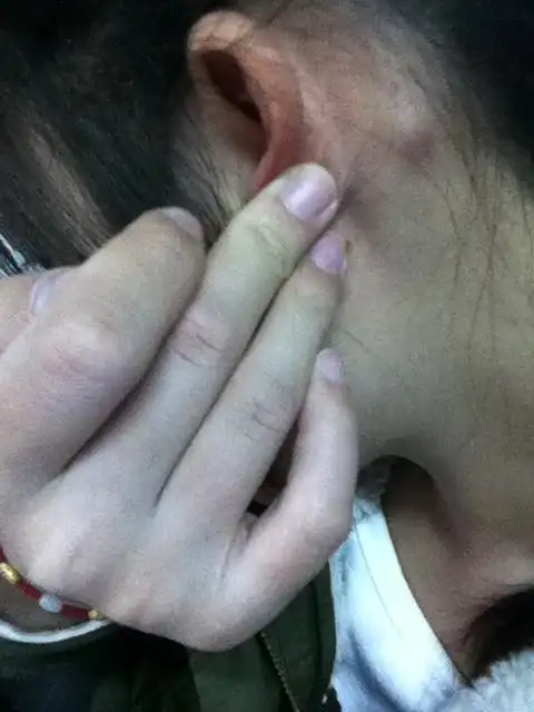 耳背后面长了个包,不痛也不痒的,包被我揉红了有影响么,有没有人能够