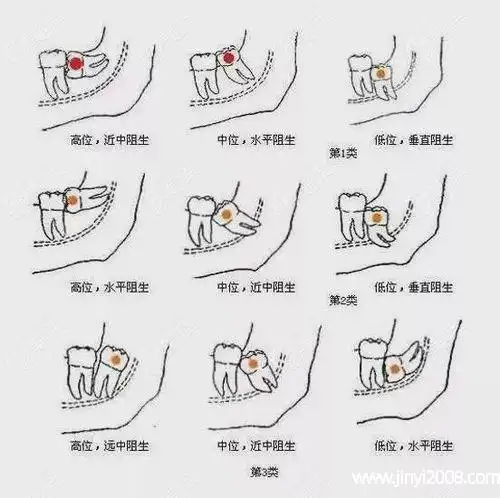 长智齿的主要原因有哪些智齿冠周炎一定要输液吗