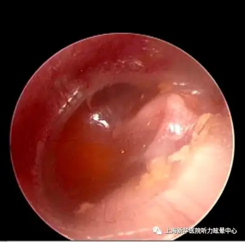 感冒后耳朵闷,原来是分泌性中耳炎_鼓膜