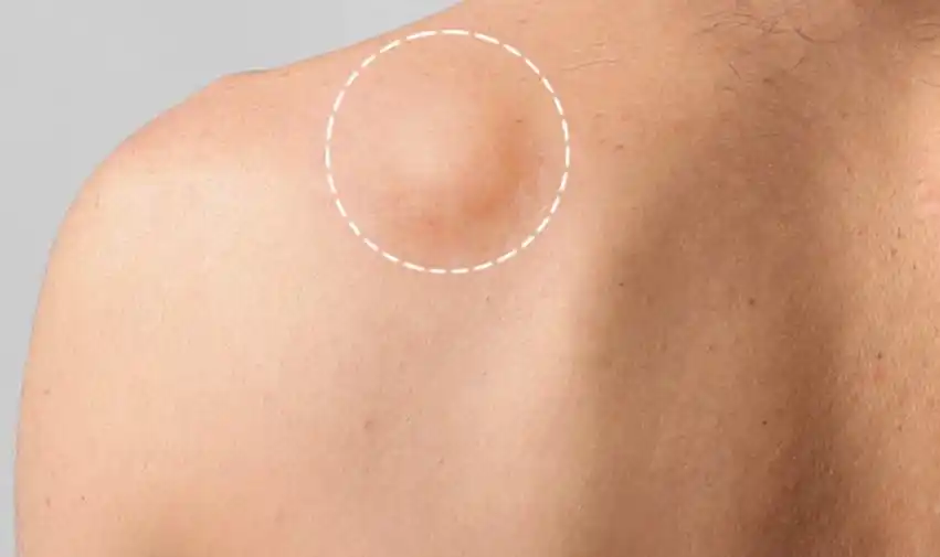 脂肪瘤是非常常见的一种由脂肪细胞组成的皮下肿瘤,通常情况下呢,会在