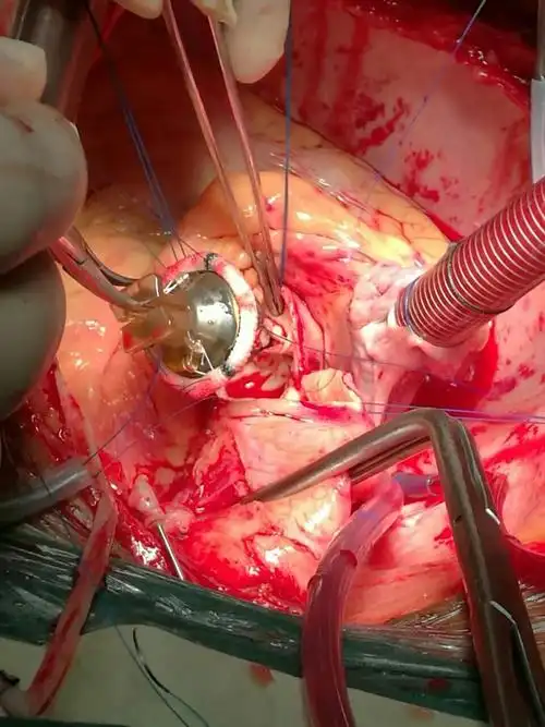 冠脉搭桥 主动脉瓣置换 二尖瓣成型术 - 好大夫在线