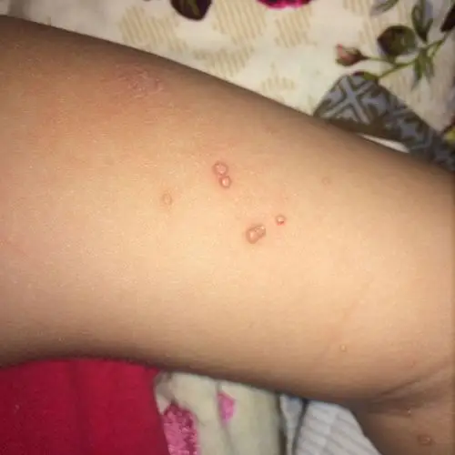 我闺女胳膊上起了好几个小水泡,直径2～3mm,有人说是瘊子,我又觉得不