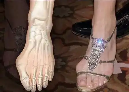 女生穿了30年高跟鞋,脚趾变形被切!