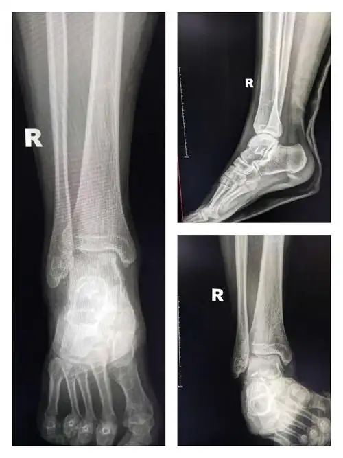 通海骨伤医院创伤骨科12月家庭随访