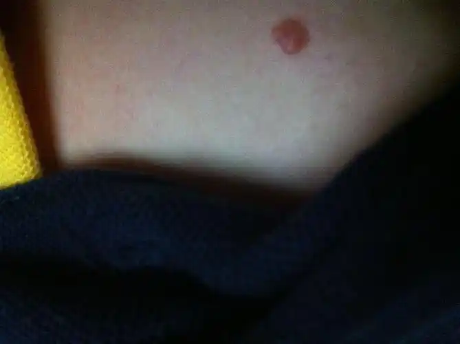 胸部长了个肉疙瘩2毫米不痛不痒 会是硬下结吗?