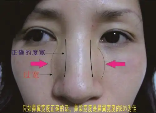 什么是宽鼻缩窄?
