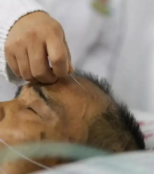 医生为一名患者进行头皮针灸治疗