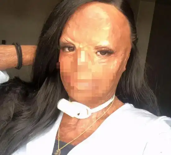 励志!英国美女意外烧伤毁容,面目全非,如今成功当上美妆博主