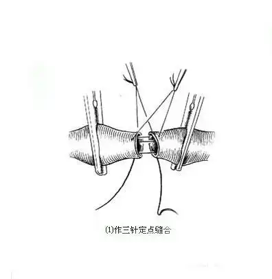 血管端端吻合术缝合法手术图解
