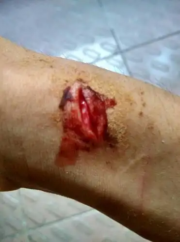 手腕上这样的伤口还可以剧烈运动吗?要多久才好啊?