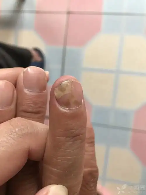 指甲疾病,请各位专业医生给看看