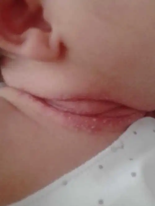 红屁股了,怎么办