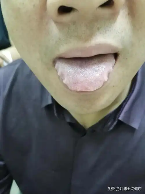 齿痕舌的意义