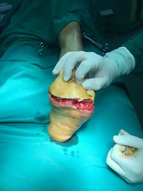 左足跖趾关节部不全离断伤