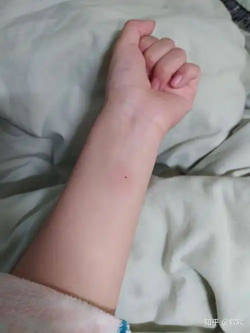 ppd皮试后这个样子怎么办? - 知乎