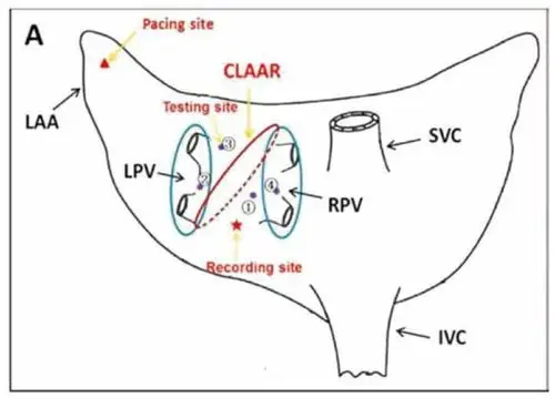 心外膜射频消融术示意图