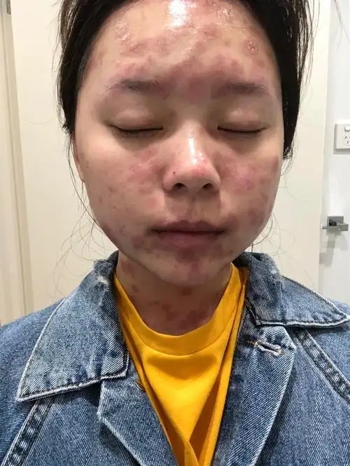 医生您好我于2019年七月份急性多形红斑治愈后留下大面积