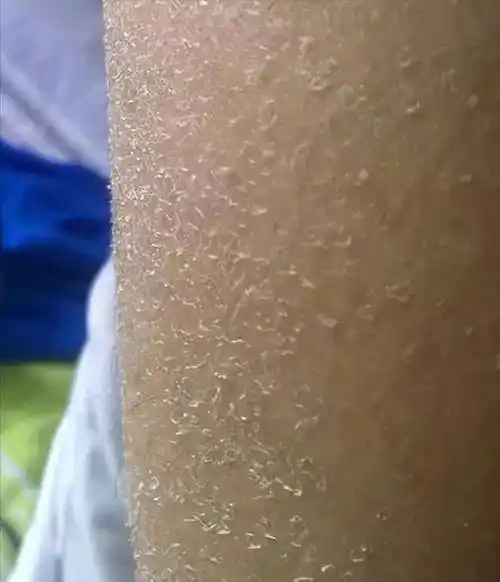 小腿皮肤开裂,是鱼鳞病吗?要不要看医生?_针对性_肌肤_地方