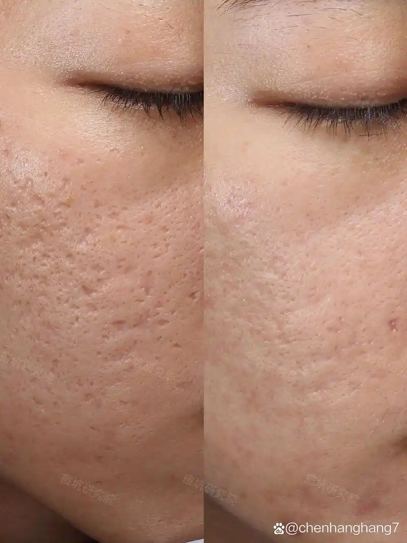 颜植痘坑研究院 的想法: 更新一组高清近距离痘坑修复前后对比图